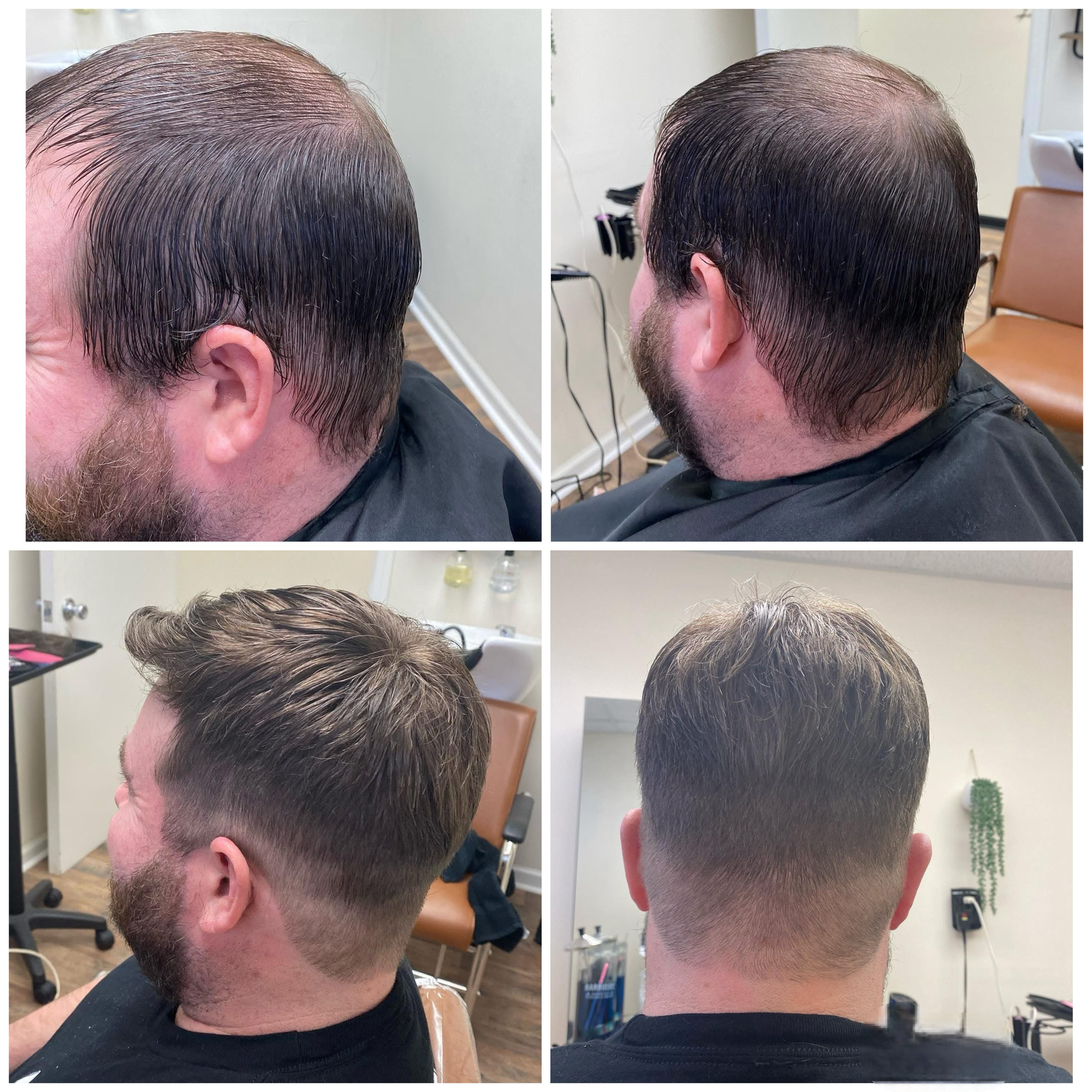 Hair Restoration